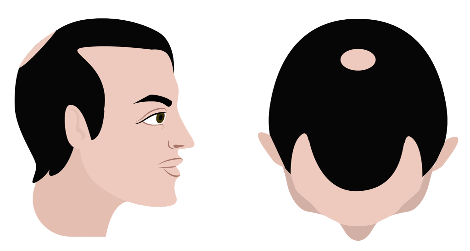 Stage 4