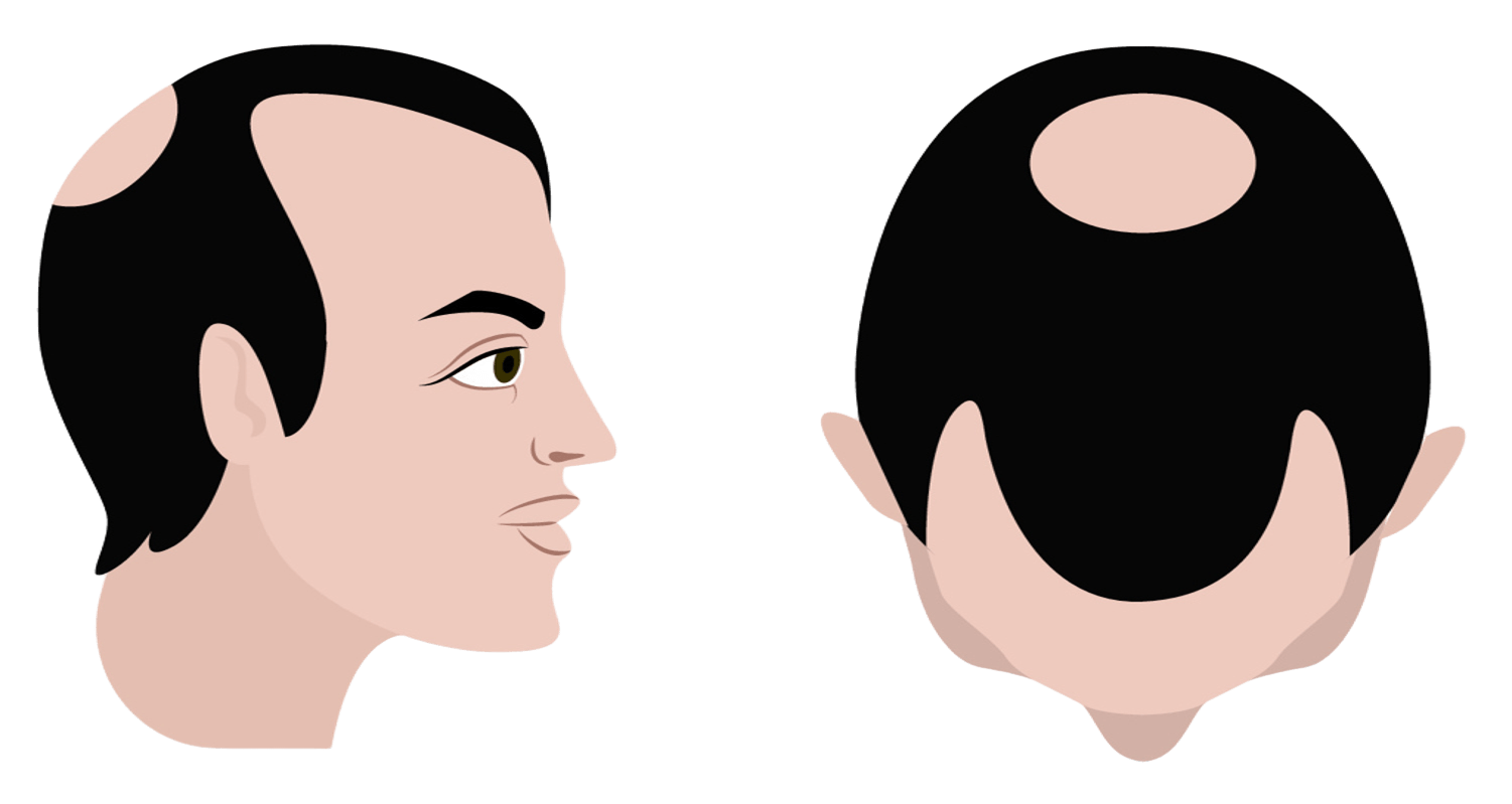 Stage 5