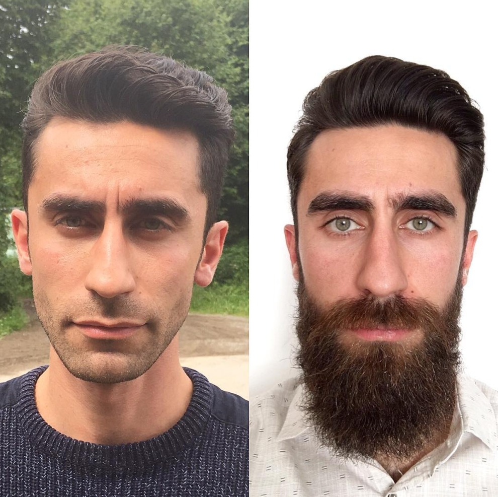 Beard and Mustache Transplant