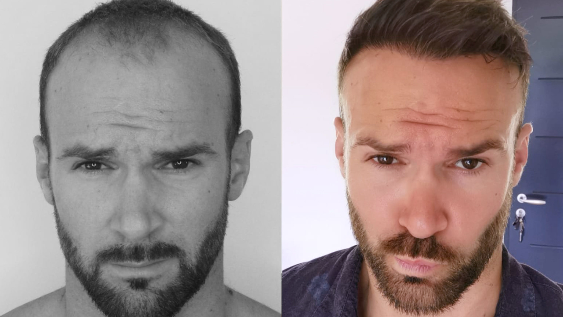 TrichoTest hair loss test
