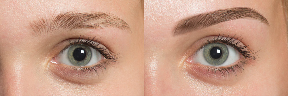 Eyebrow transplant FUE
