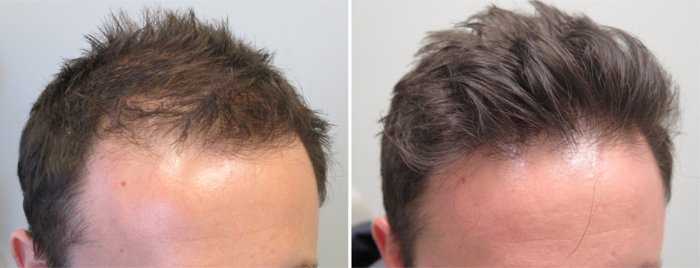 Minoxidil 5% for hair regrowth