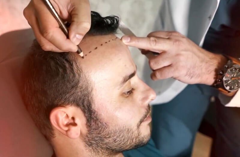 FUE matu pārstādīšana